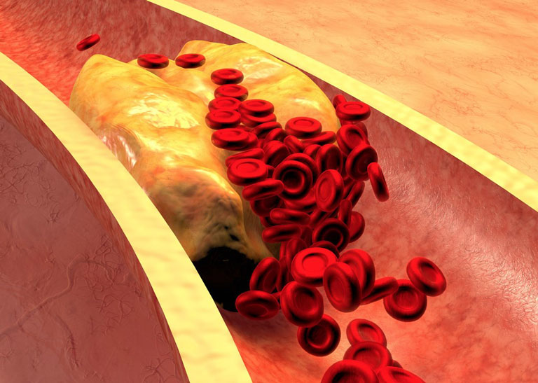 What You Need To Know About Cholesterol