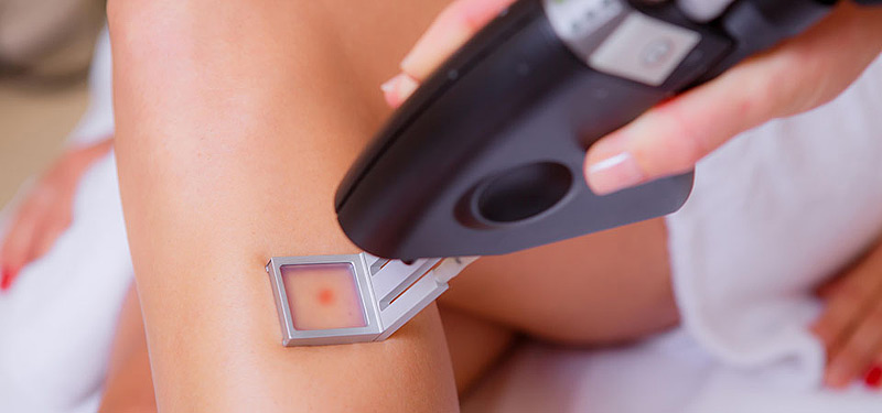 The Laser Hair Removal Guide