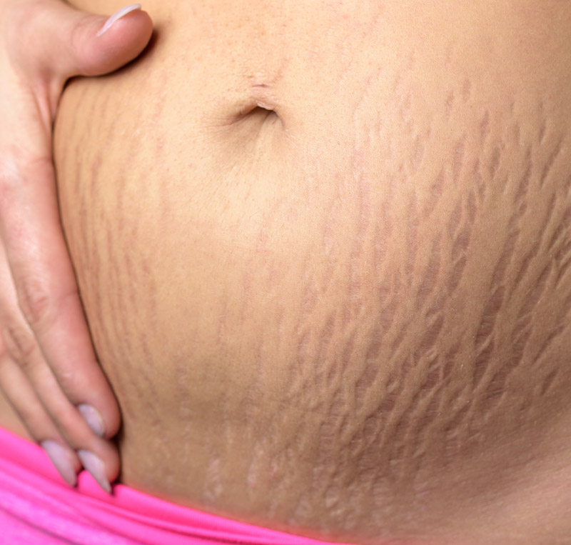 How to Naturally Get Rid of Stretch Marks