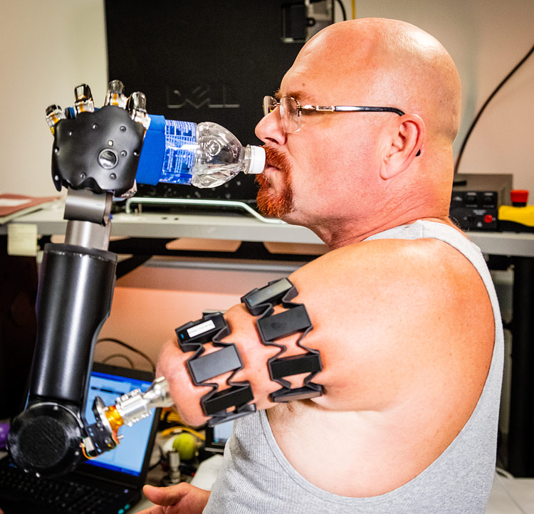 Prosthetic Limb Reaches New Levels of Operability