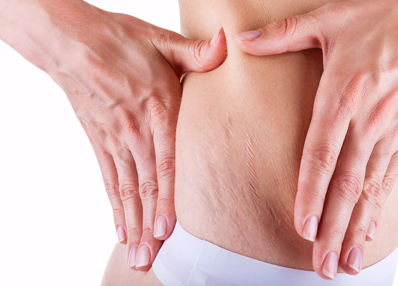 How to Naturally Get Rid of Stretch Marks