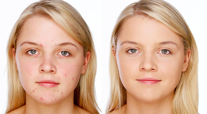 How to Flawlessly Cover Up Skin Imperfections