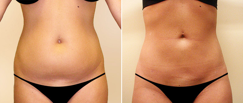 Thinking About Liposuction? Read This First!