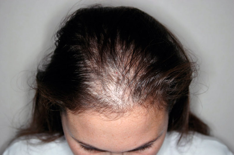 10 Reasons Why Women Too Suffer From Hair Loss