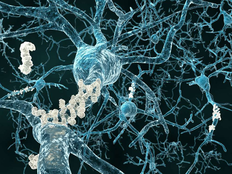 Aducanumab - Reduces plaques in Alzheimer's disease