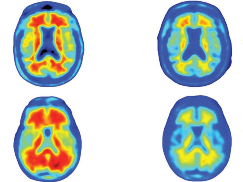 Aducanumab - Reduces plaques in Alzheimer's disease