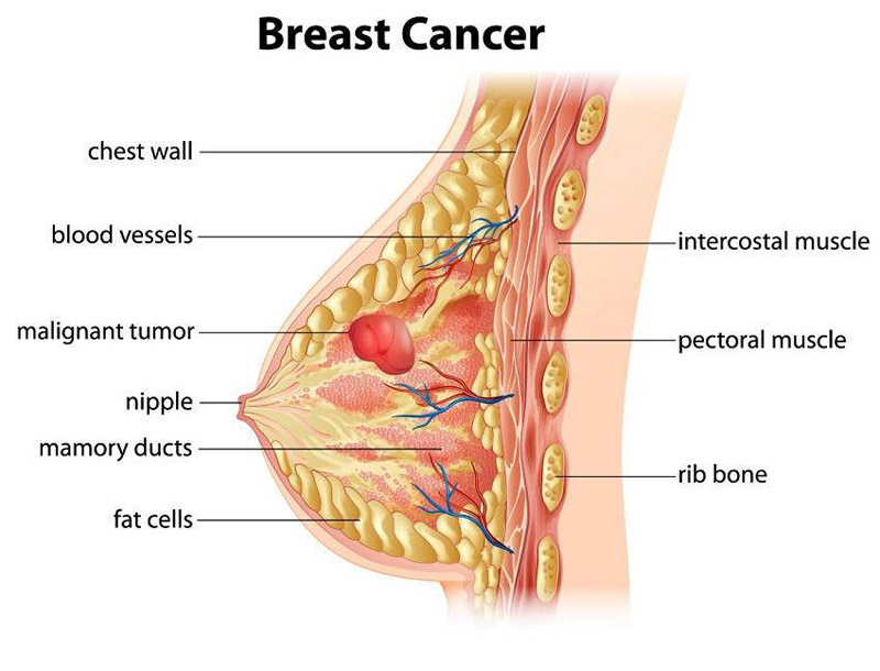 Why Women in China Rarely Get Breast Cancer