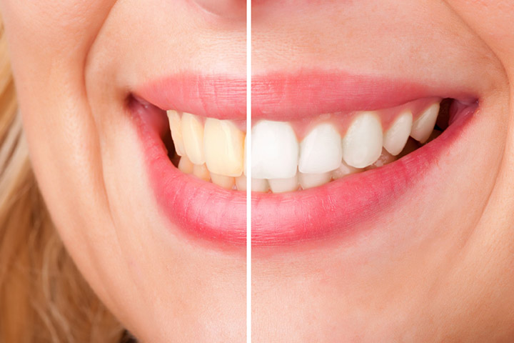 Why Should You Visit a Cosmetic Dentist?