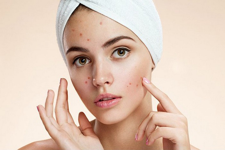 How to Get Rid Of Pimples?