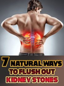 7 Natural Ways to Flush Out Kidney Stones