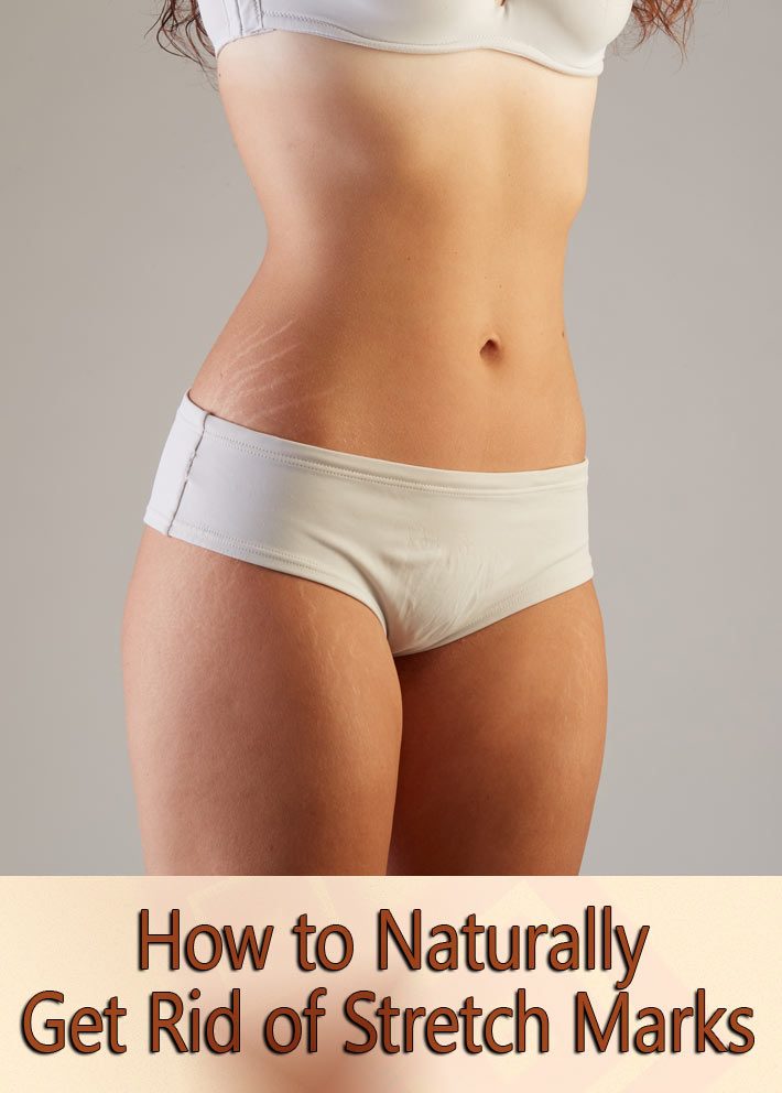 How to Naturally Get Rid of Stretch Marks