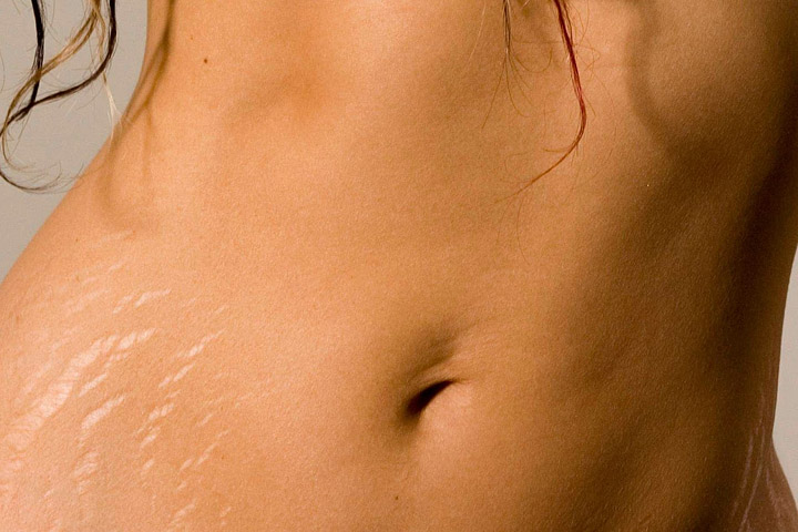 How to Naturally Get Rid of Stretch Marks