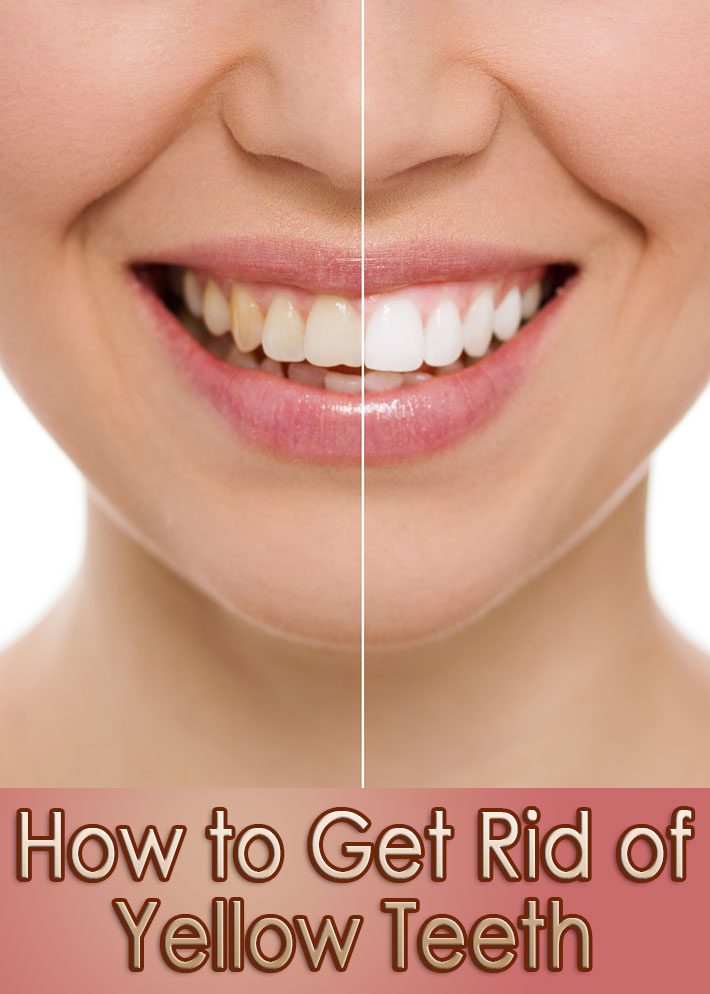 How to Get Rid of Yellow Teeth