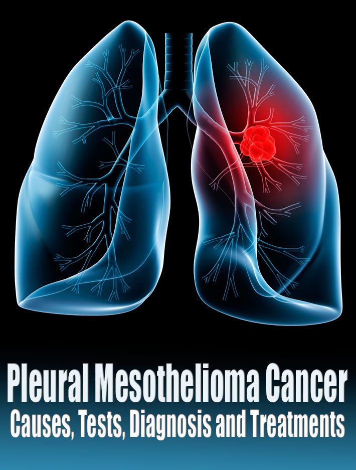 mesothelioma late stage symptoms